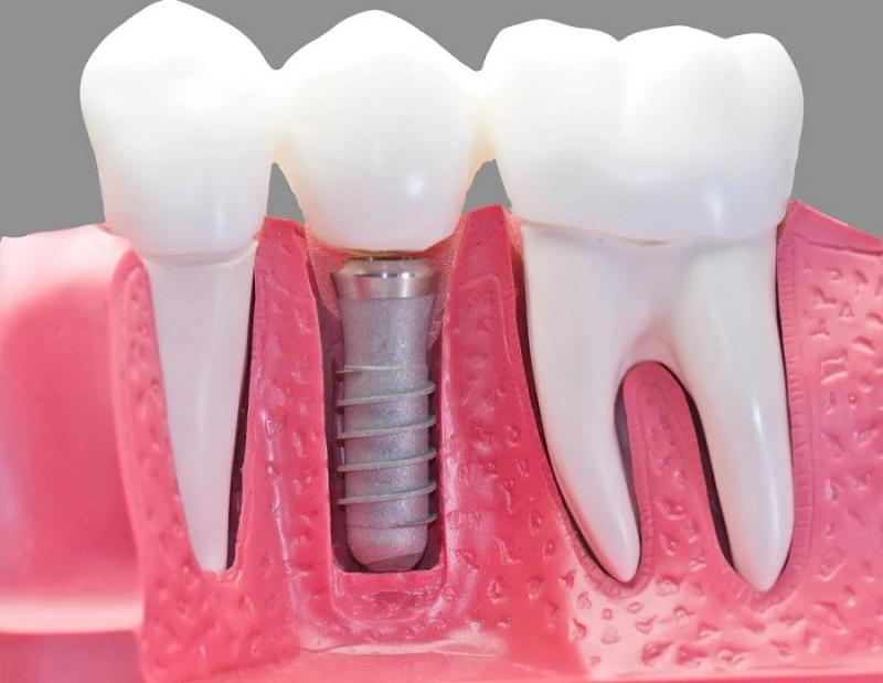 Global Single Tooth Implants and Dental Bridges Market , By Type , By Applications , By Regions – Global Forecast to 2029